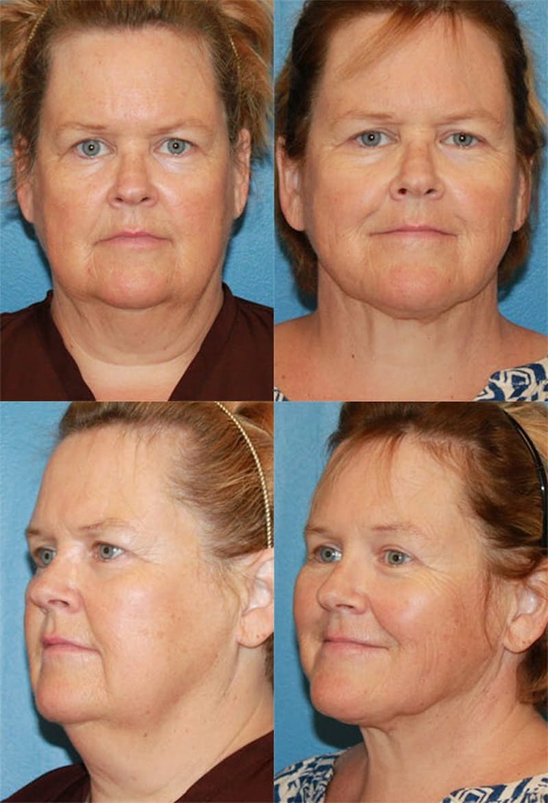 Neck Liposuction Before & After Gallery - Patient 2158376 - Image 1