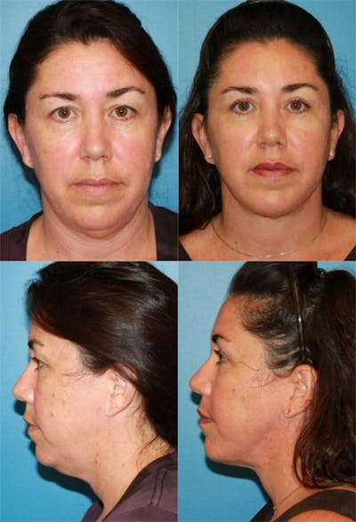 Neck Liposuction Before & After Gallery - Patient 2158377 - Image 1