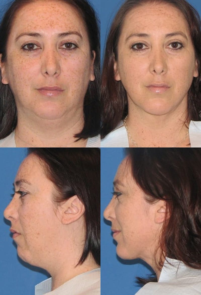 Neck Liposuction Before & After Gallery - Patient 2158378 - Image 1