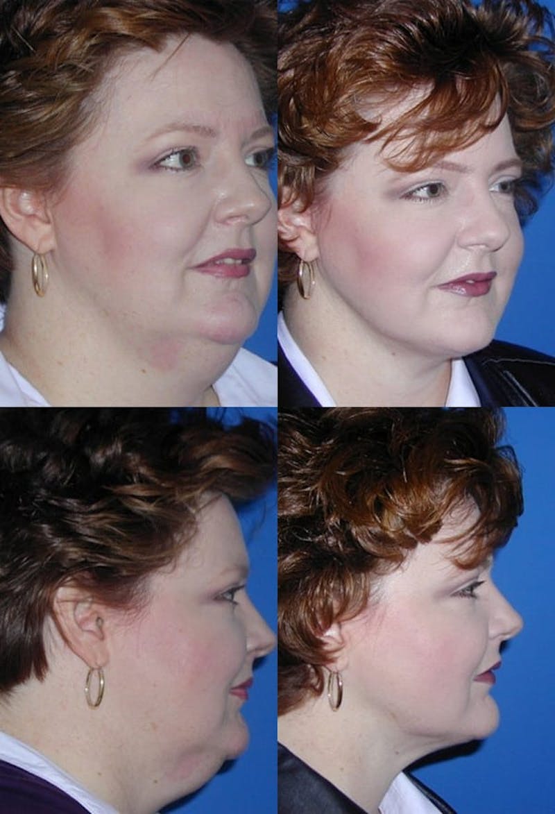 Neck Liposuction Before & After Gallery - Patient 2158382 - Image 1