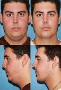 Neck Liposuction Before & After Gallery - Patient 2158384 - Image 1