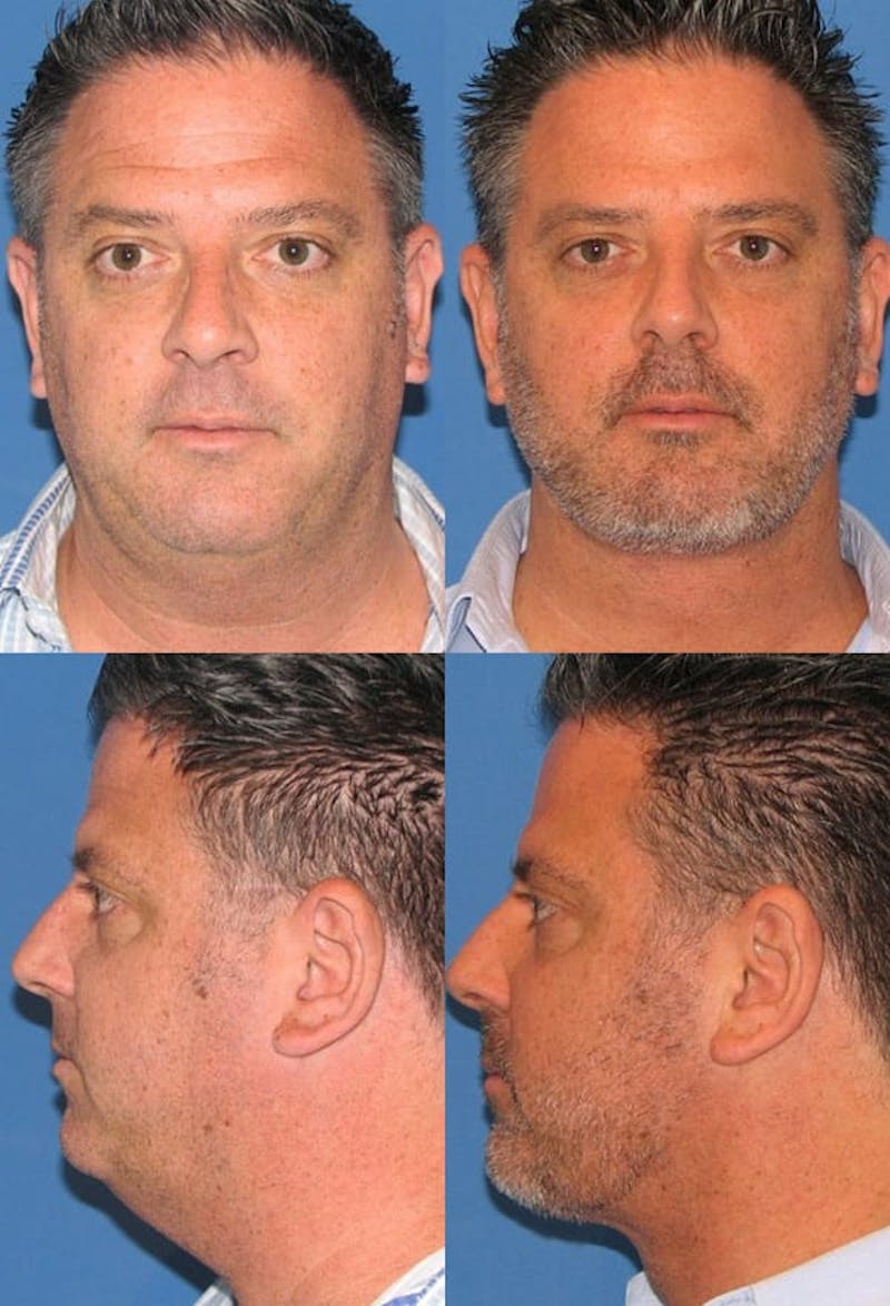 Neck Liposuction Before & After Gallery - Patient 2158385 - Image 1