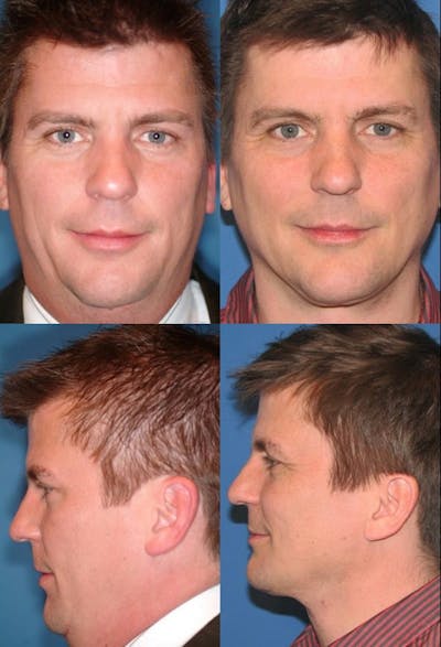 Neck Liposuction Before & After Gallery - Patient 2158391 - Image 1