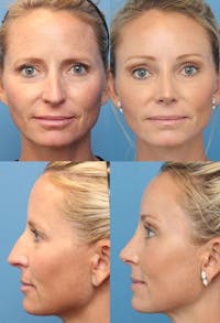 Rhinoplasty Before & After Gallery - Patient 2158393 - Image 1