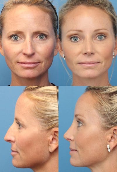 Rhinoplasty Before & After Gallery - Patient 2158393 - Image 1