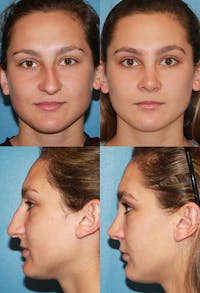 Rhinoplasty Before & After Gallery - Patient 2158398 - Image 1