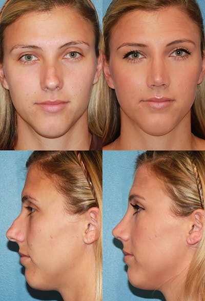 Female Rhinoplasty Before & After Gallery - Patient 2388184 - Image 1