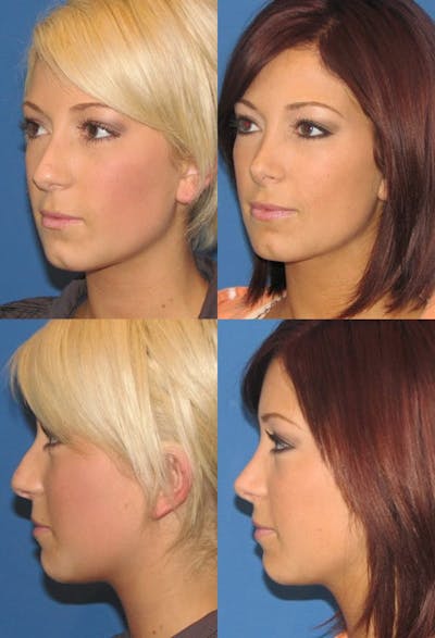 Rhinoplasty Before & After Gallery - Patient 2158403 - Image 1