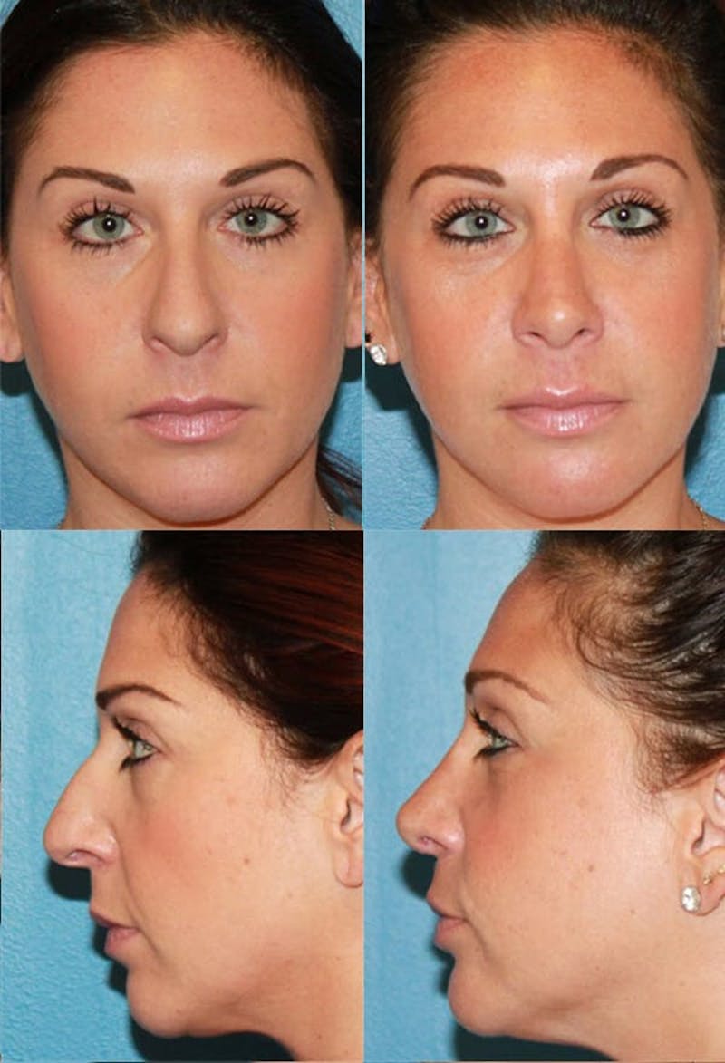 Rhinoplasty Before & After Gallery - Patient 2158408 - Image 1