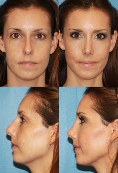 Female Rhinoplasty Before & After Gallery - Patient 2388190 - Image 1