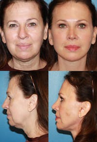 Rhinoplasty Before & After Gallery - Patient 2158413 - Image 1