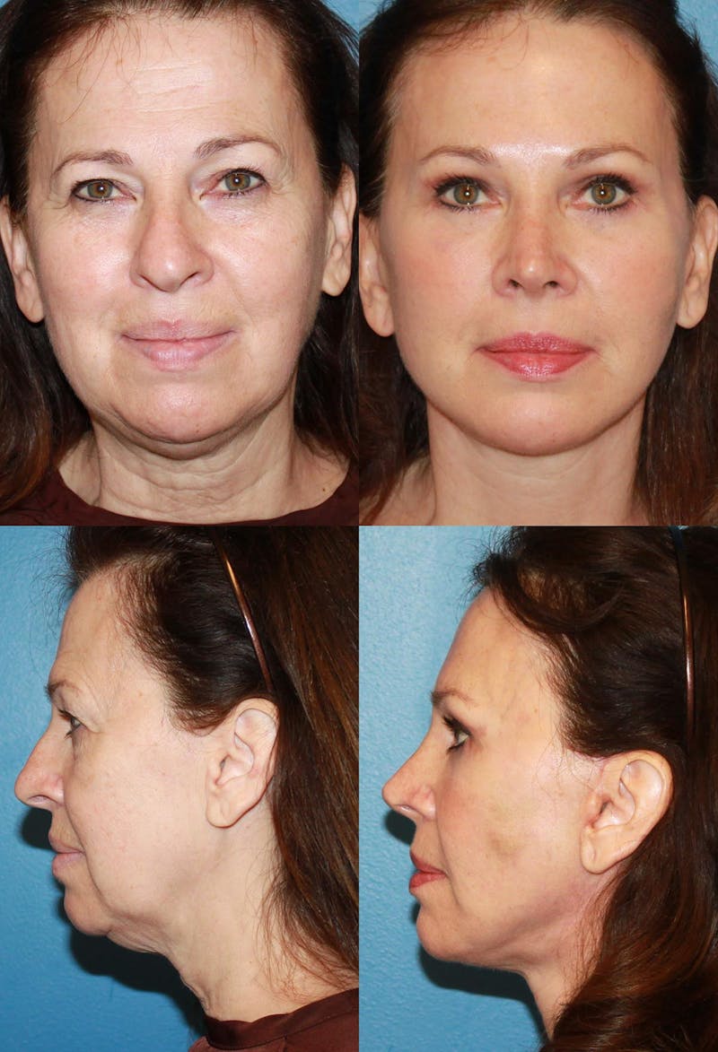 Female Rhinoplasty Before & After Gallery - Patient 2388193 - Image 1