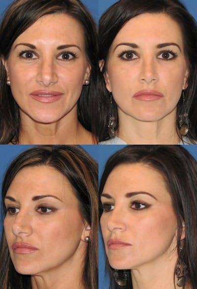Female Rhinoplasty Before & After Gallery - Patient 2388197 - Image 1