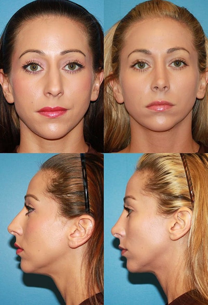 Rhinoplasty Before & After Gallery - Patient 2158420 - Image 1