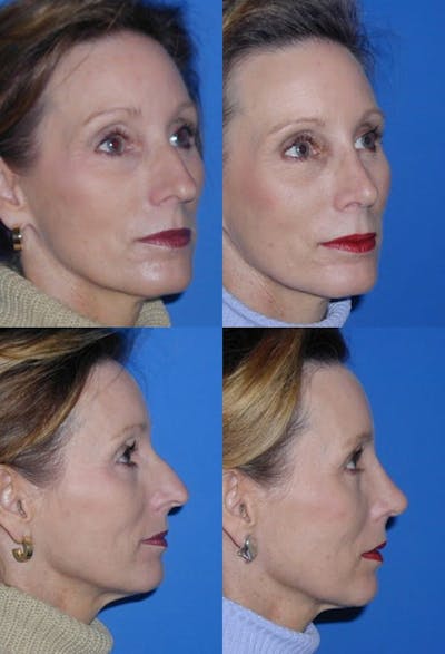 Female Rhinoplasty Before & After Gallery - Patient 2388199 - Image 1