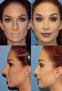 Female Bulbous Tip Before & After Gallery - Patient 2388241 - Image 1
