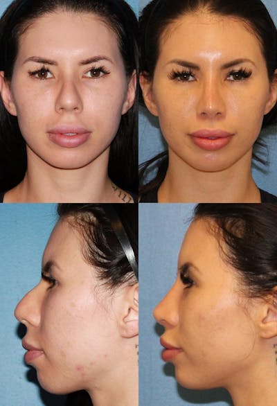Female Bulbous Tip Before & After Gallery - Patient 2388242 - Image 1