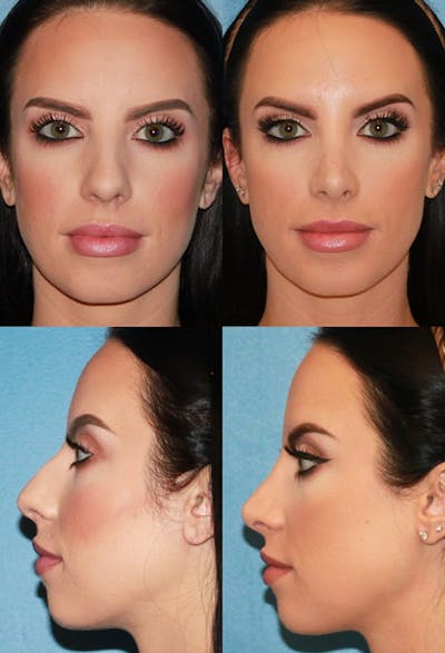 Rhinoplasty Before & After Gallery - Patient 2158436 - Image 1