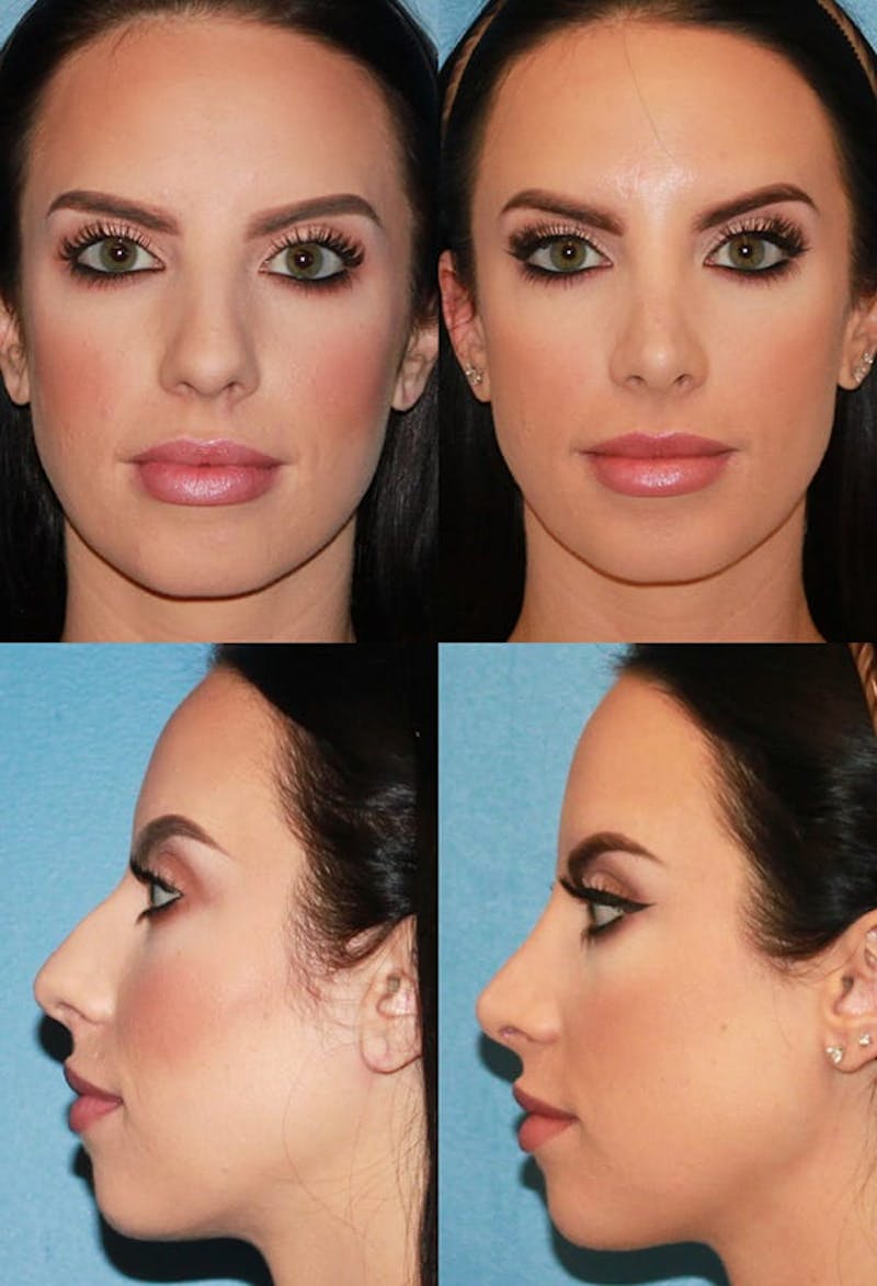 Rhinoplasty Before & After Gallery - Patient 2158436 - Image 1
