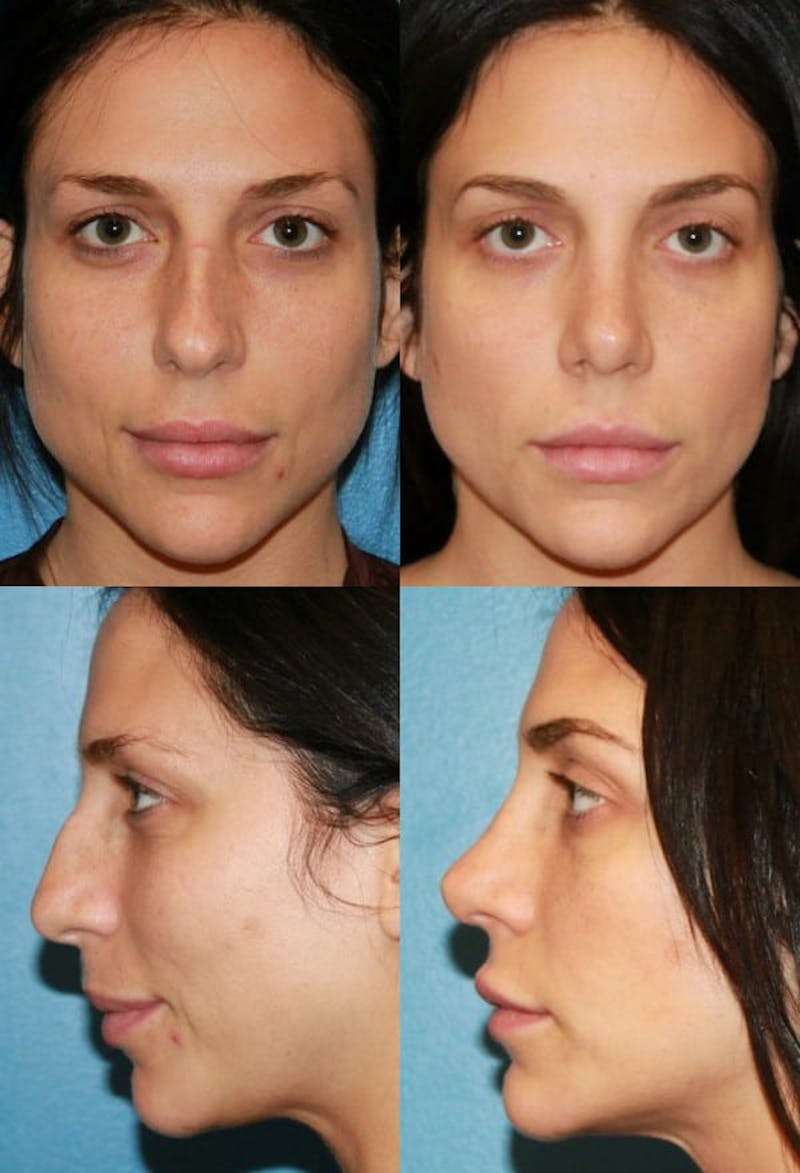 Female Bulbous Tip Before & After Gallery - Patient 2388244 - Image 1