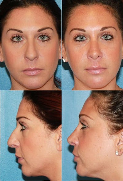 Female Bulbous Tip Before & After Gallery - Patient 2388246 - Image 1