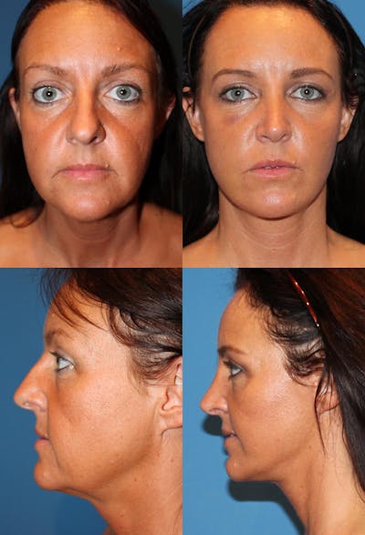 Female Bulbous Tip Before & After Gallery - Patient 2388247 - Image 1