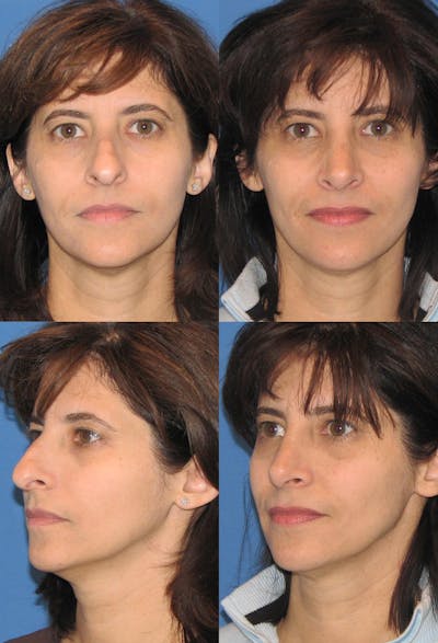 Female Bulbous Tip Before & After Gallery - Patient 2388248 - Image 1