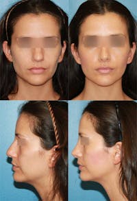 Rhinoplasty Before & After Gallery - Patient 2158449 - Image 1