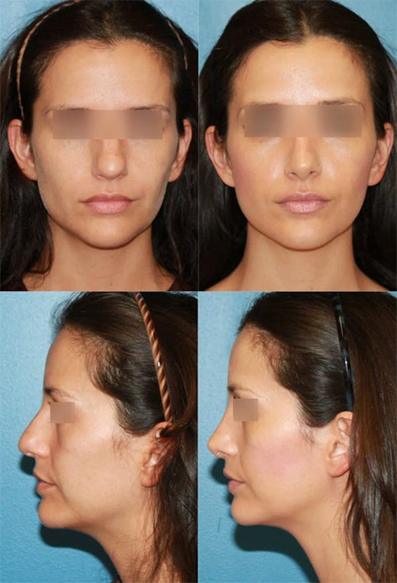 Female Bulbous Tip Before & After Gallery - Patient 2388251 - Image 1