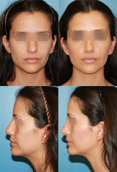 Female Bulbous Tip Before & After Gallery - Patient 2388251 - Image 1