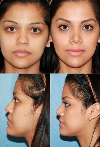 Female Bulbous Tip Before & After Gallery - Patient 2388252 - Image 1