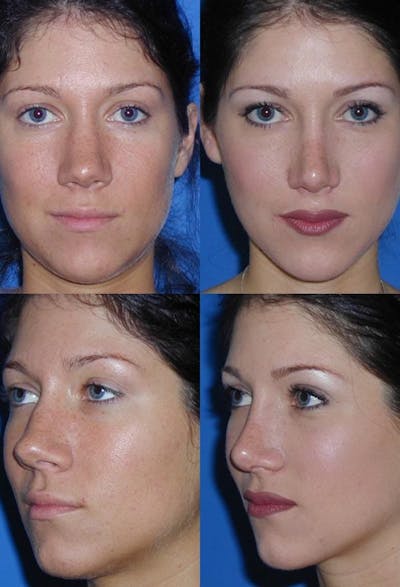 Rhinoplasty Before & After Gallery - Patient 2158451 - Image 1