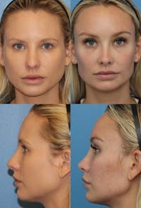 Rhinoplasty Before & After Gallery - Patient 2158453 - Image 1