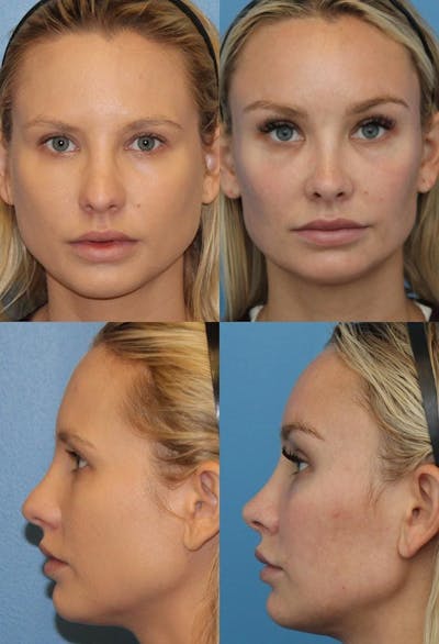 Rhinoplasty Before & After Gallery - Patient 2158453 - Image 1