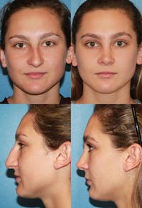 Female Drooping Tip Before & After Gallery - Patient 2388255 - Image 1