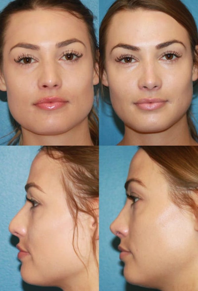 Female Drooping Tip Before & After Gallery - Patient 2388257 - Image 1