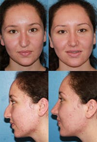 Female Drooping Tip Before & After Gallery - Patient 2388259 - Image 1