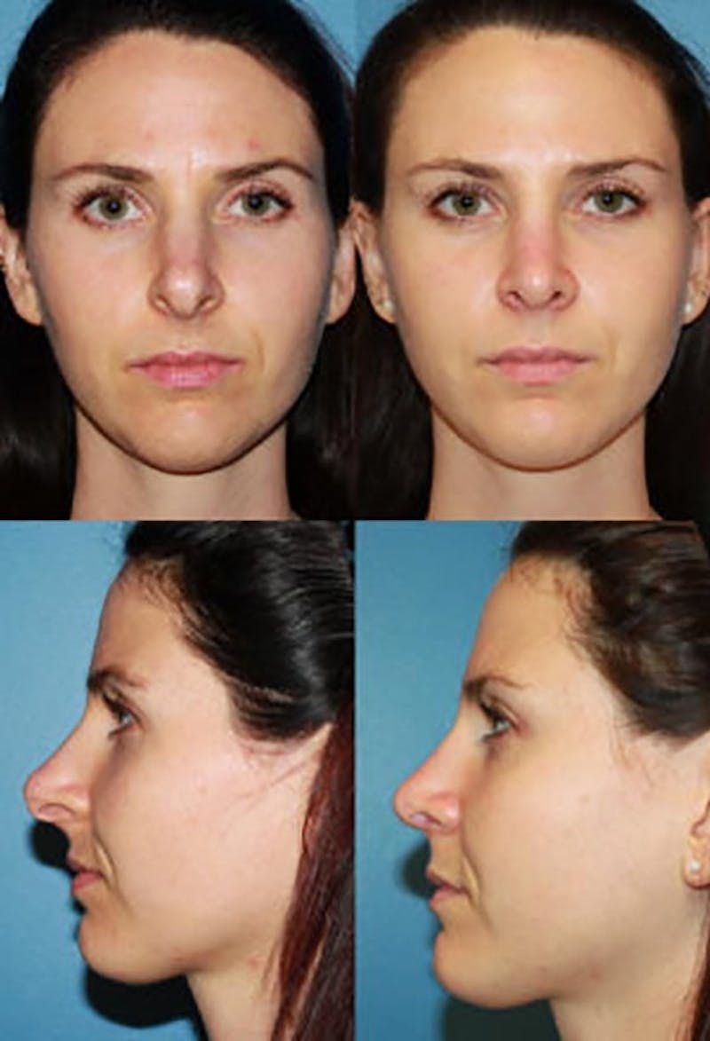 Female Prominent Nostril / Hanging Columella Before & After Gallery - Patient 2388267 - Image 1
