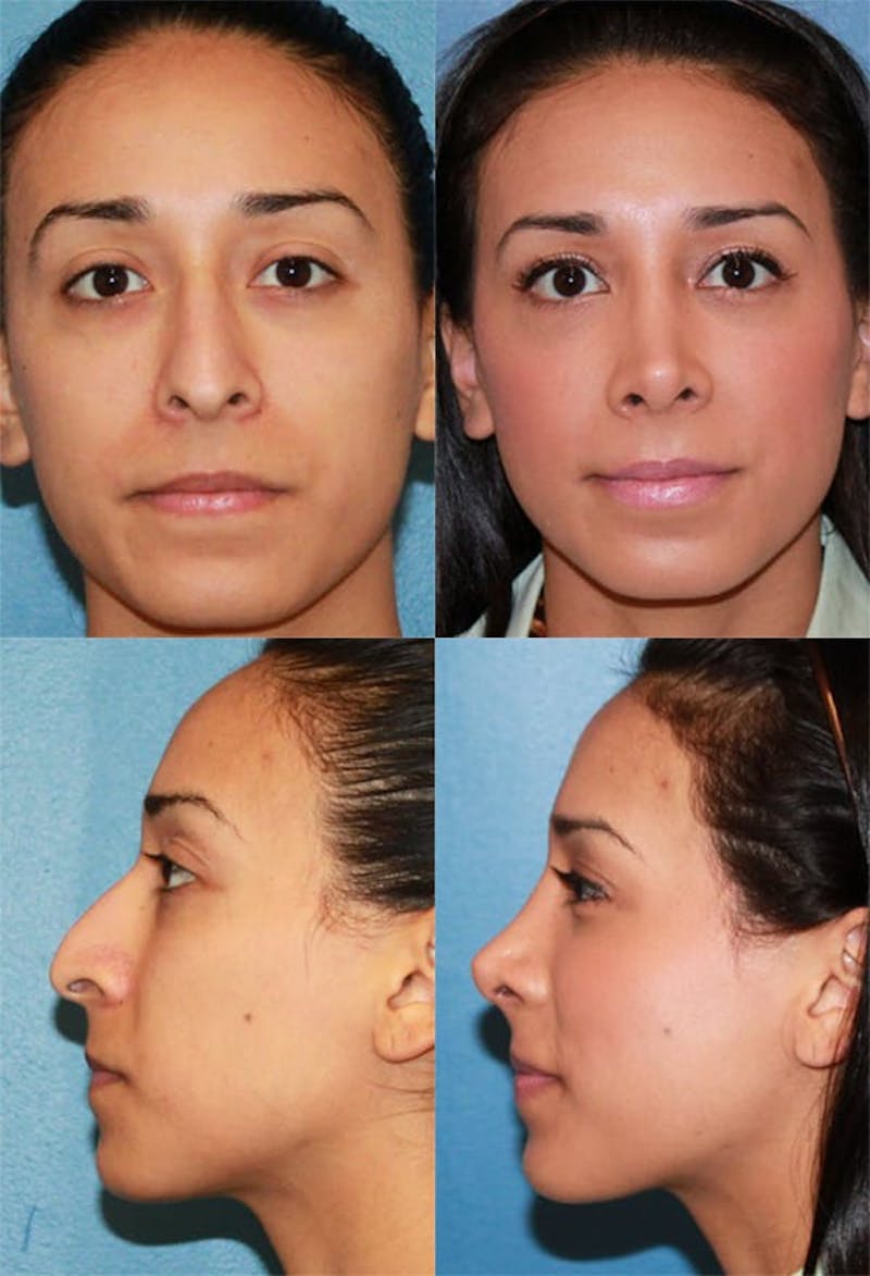 Rhinoplasty Before & After Gallery - Patient 2158461 - Image 1