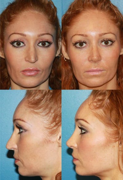 Crooked Nose Before & After Gallery - Patient 2388272 - Image 1