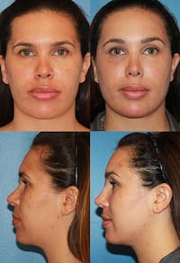 Rhinoplasty Before & After Gallery - Patient 2158473 - Image 1