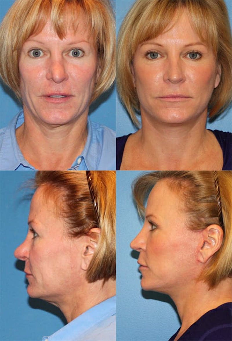 Female Revision Rhinoplasty Before & After Gallery - Patient 2388300 - Image 1