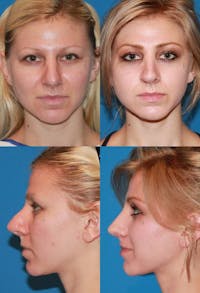 Rhinoplasty Before & After Gallery - Patient 2158479 - Image 1