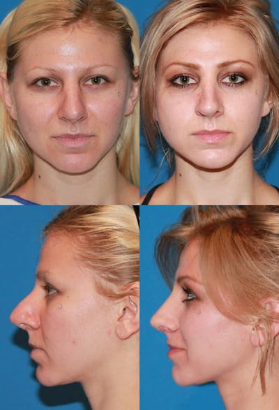 Female Revision Rhinoplasty Before & After Gallery - Patient 2388301 - Image 1