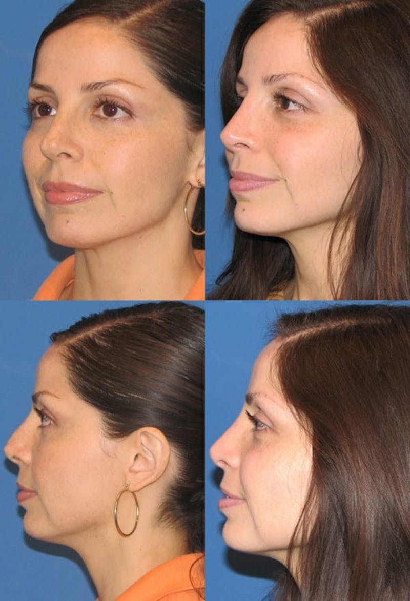 Rhinoplasty Before & After Gallery - Patient 2158480 - Image 1