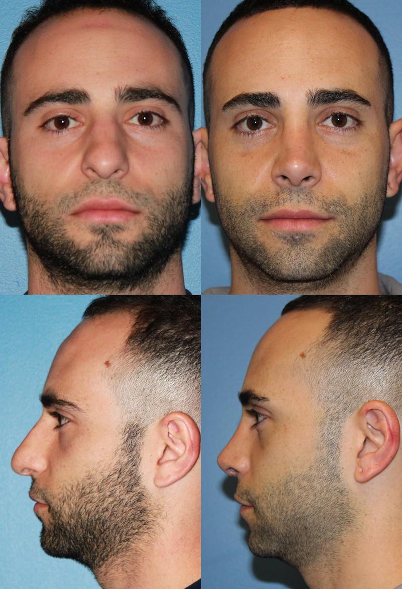 Rhinoplasty Before & After Gallery - Patient 2158482 - Image 1