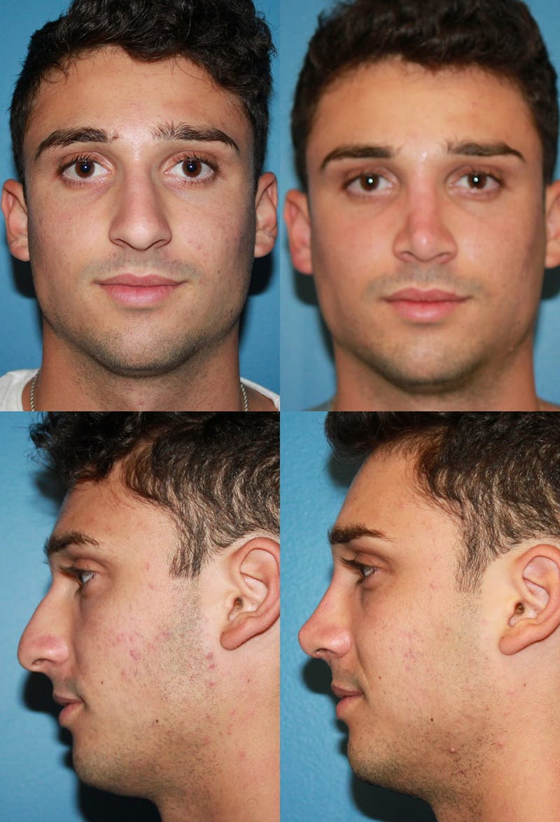 Rhinoplasty Before & After Gallery - Patient 2158484 - Image 1