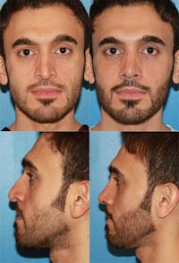 Male Rhinoplasty Before & After Gallery - Patient 2388288 - Image 1