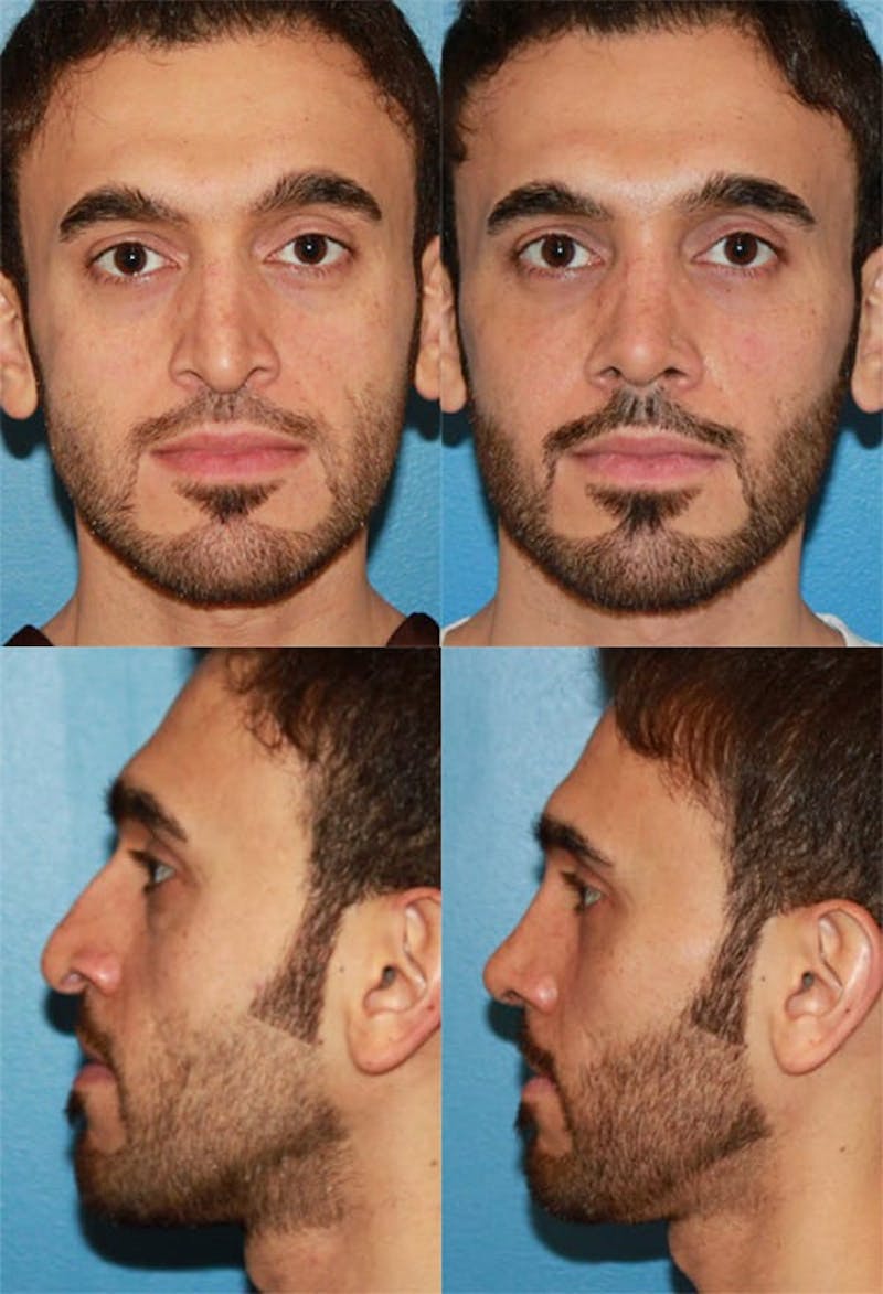 Male Rhinoplasty Before & After Gallery - Patient 2388288 - Image 1