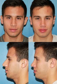Male Rhinoplasty Before & After Gallery - Patient 2388289 - Image 1